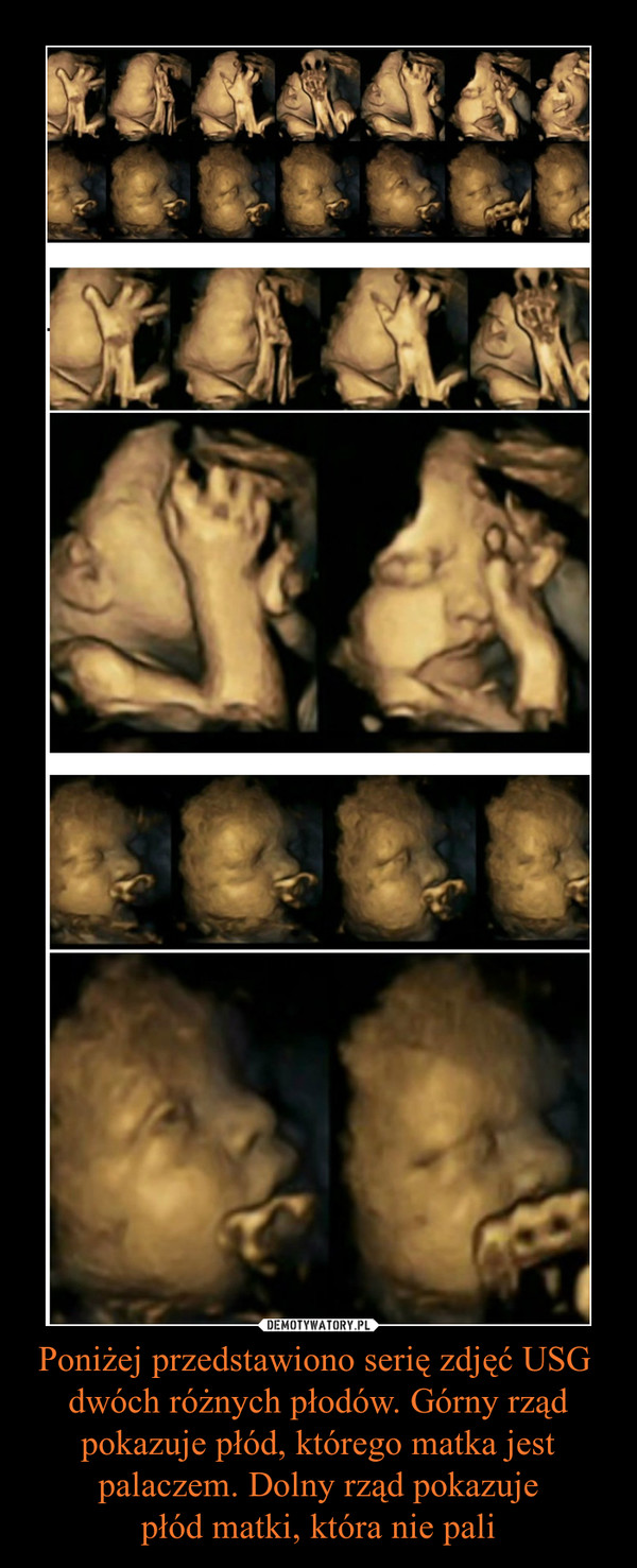 Poniżej przedstawiono serię zdjęć USG 
dwóch różnych płodów. Górny rząd pokazuje płód, którego matka jest palaczem. Dolny rząd pokazuje
płód matki, która nie pali