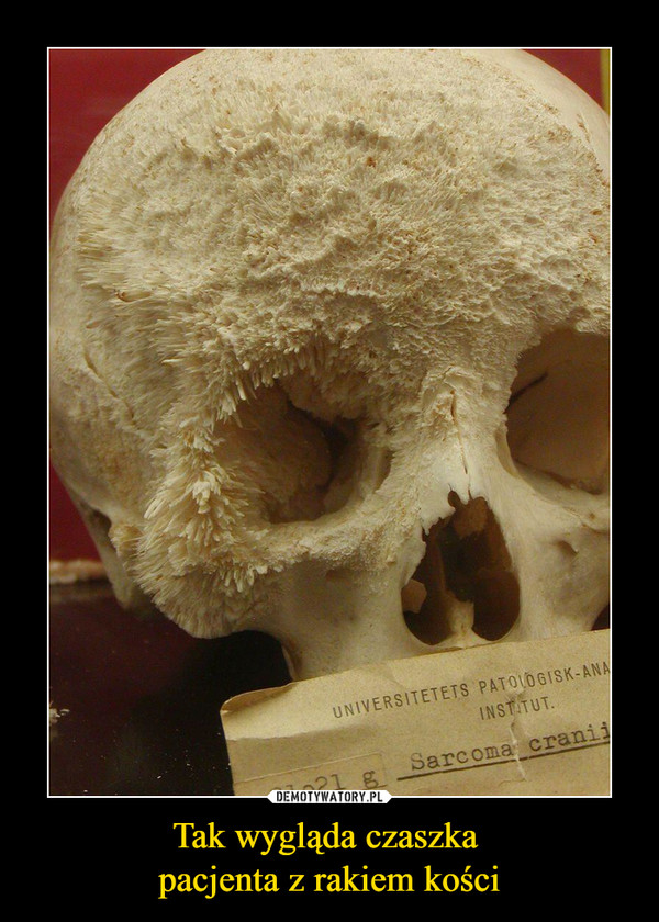 Tak wygląda czaszka pacjenta z rakiem kości –  
