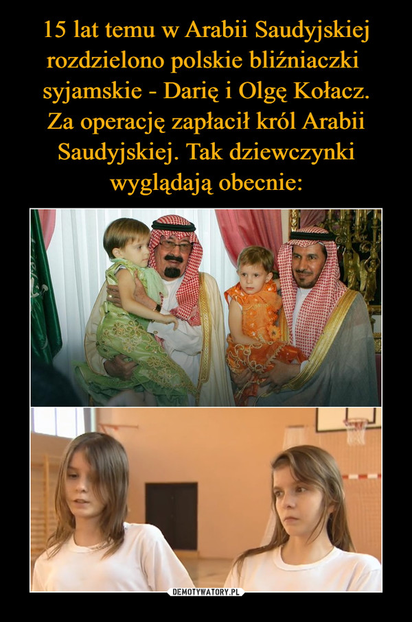15 lat temu w Arabii Saudyjskiej rozdzielono polskie bliźniaczki  syjamskie - Darię i Olgę Kołacz.
Za operację zapłacił król Arabii Saudyjskiej. Tak dziewczynki wyglądają obecnie: