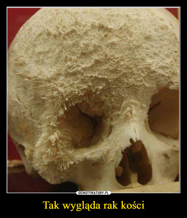 Tak wygląda rak kości