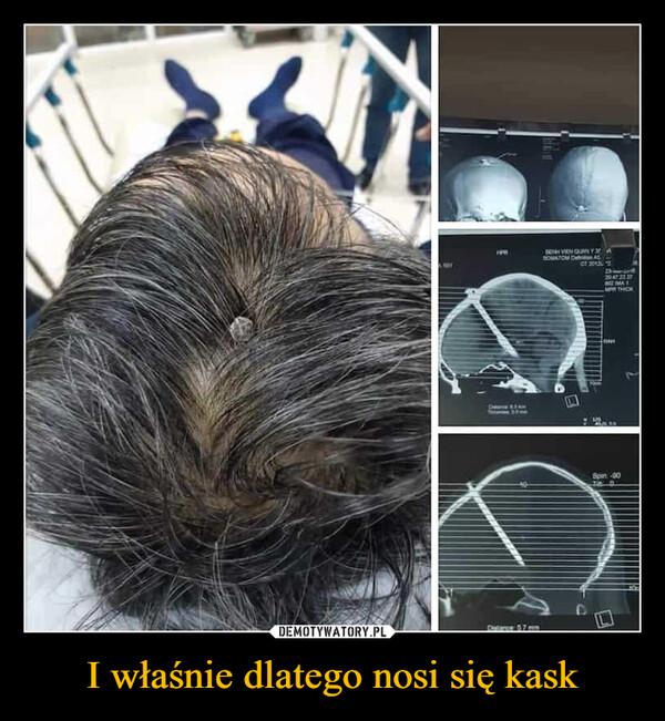 I właśnie dlatego nosi się kask –  SON VIEN GUMY ASOMATOM DALCT 2013072014Y2237AMPR THO3Data 57mm8pn-90D